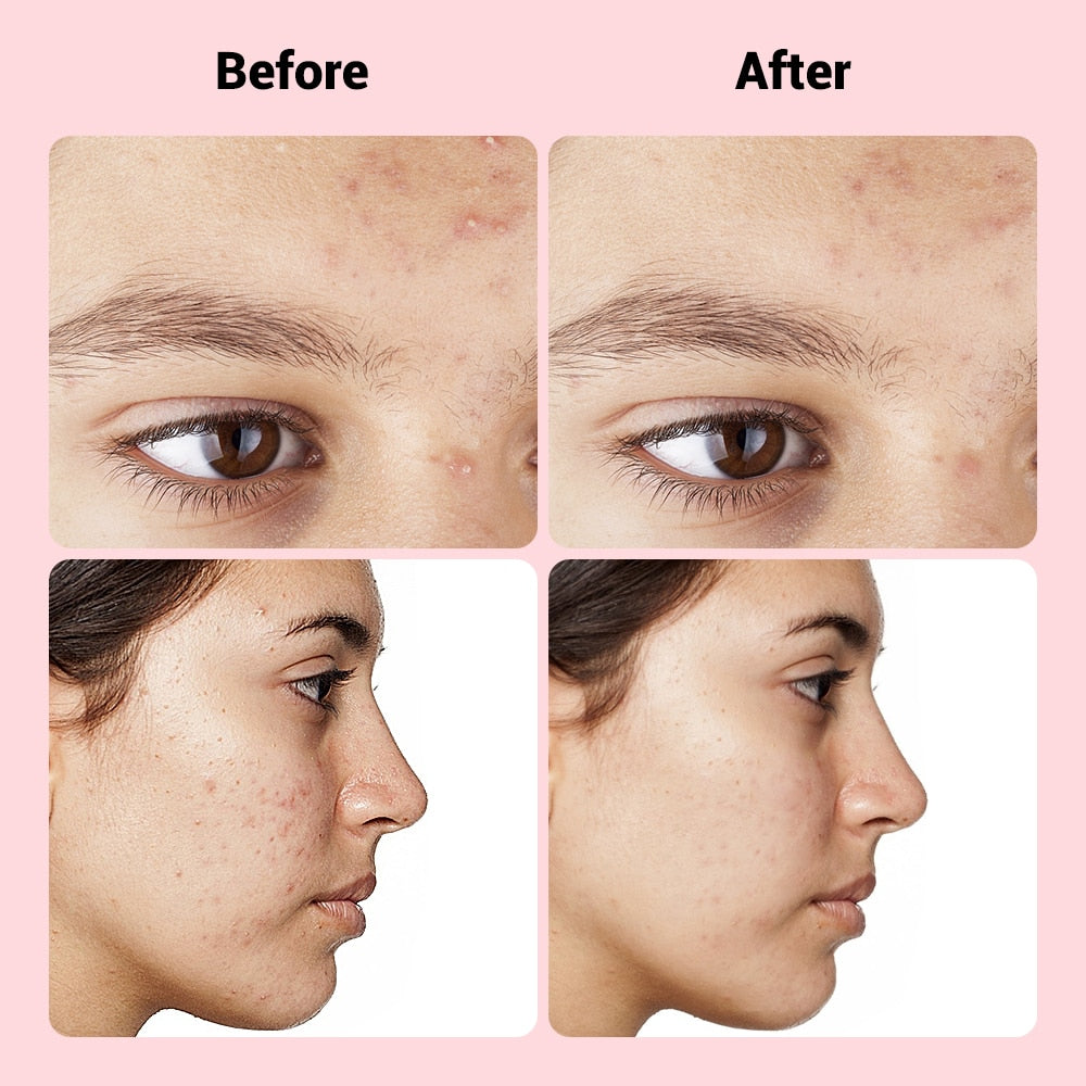 Microneedle Pimple Patches – Acne Treatment Stickers (9pcs)