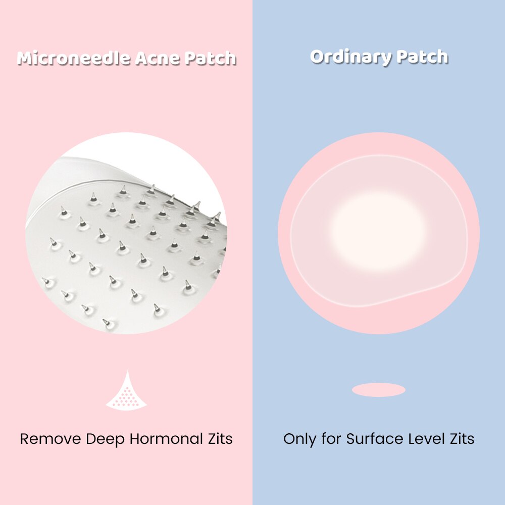 Microneedle Pimple Patches – Acne Treatment Stickers (9pcs)